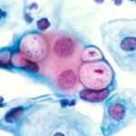 pemeriksaan pap smear