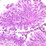 tumor ganas
