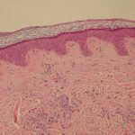 tumor jinak