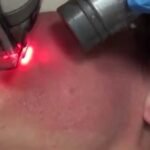Terapi Laser Membuat Wajah Terlihat Lebih Muda